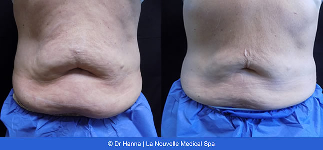 Coolsculpting before after photos, La Nouvelle Medical Spa, Oxnard, Ventura county  