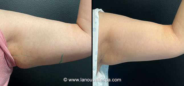 Coolsculpting before after photos arm, La Nouvelle Medical Spa, Oxnard, Ventura county  