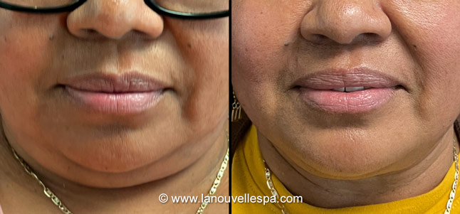 Coolsculpting before after photos neck front, La Nouvelle Medical Spa, Oxnard, Ventura county  
